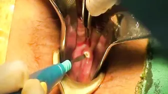 Anal fistula, coring out with IO closure #2