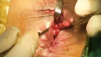 Anal fistula, coring out with IO closure #3