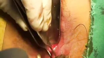 Anal fistula, coring out with IO closure #4