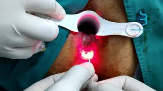 Anal Fistula