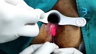 Anal Fistula #2