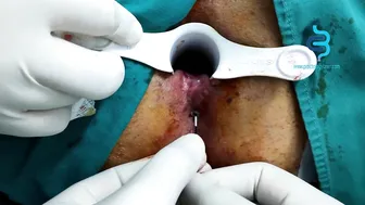 Anal Fistula #3