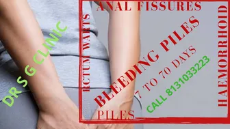 PILES/ HAEMORRHOID/RECTUM PAIN/FISTULA ANO/RECTAL PROLAPSE/CANCER/BLEEDING PILES/ANAL FISSURES/PILS