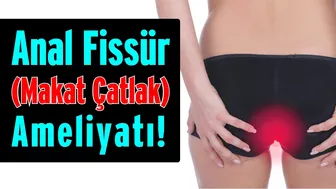 Anal fissür (makat çatlak) Ameliyatı? Anal fissür nedir? neden oluşur?