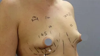 Addressing tuberous breast deformity