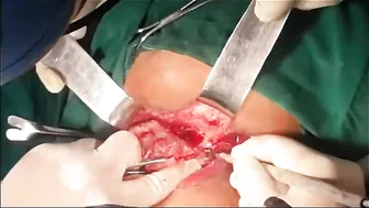 Posterior Transsphincteric Recurrent Anal Fistula #2