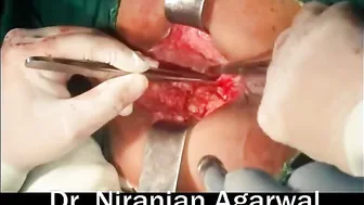 Posterior Transsphincteric Recurrent Anal Fistula #3