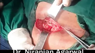 Posterior Transsphincteric Recurrent Anal Fistula #4