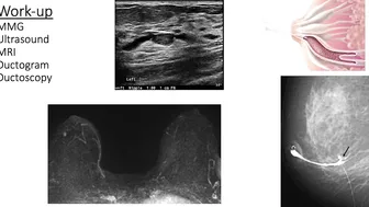 Benign Breast: Lesions to Know - Dr Stephanie Valente #3