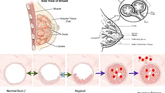 Benign Breast: Lesions to Know - Dr Stephanie Valente #4