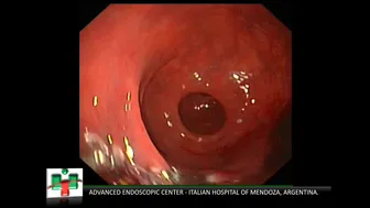 Endoscopic mucosal resection (EMR) of laterally spreading tumor in rectum and bleeding resolution