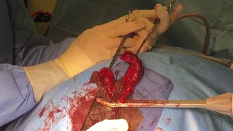 Rectal Prolapse /Prolapsed Internal Hemorrhoids