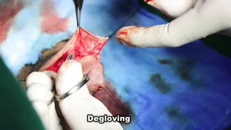 STAG REPAIR FOR FAILED HYPOSPADIAS IN ADULT (FIRST STAGE) #2