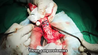 STAG REPAIR FOR FAILED HYPOSPADIAS IN ADULT (FIRST STAGE) #3