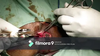 Y V Stricturoplasty for Anal Stenosis #2