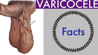 VARICOCELE - हिंदी में सब कुछ