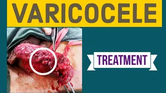 VARICOCELE