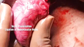 VARICOCELE #4