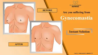 Gynecomastia Perfect Result | Male Breast Reduction Procedure | Dr Monisha Kapoor