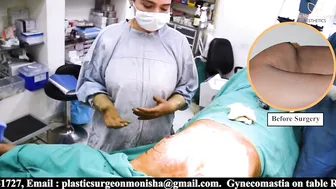 Gynecomastia Perfect Result | Male Breast Reduction Procedure | Dr Monisha Kapoor #4