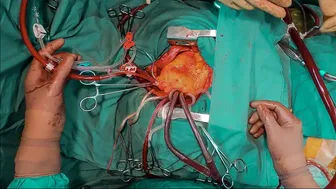 First Person Heart Surgery: From Skin Incision to Heart Arrest