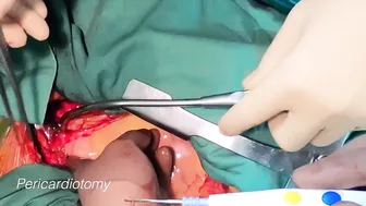 First Person Heart Surgery: From Skin Incision to Heart Arrest #2