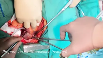 First Person Heart Surgery: From Skin Incision to Heart Arrest #3