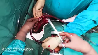 First Person Heart Surgery: From Skin Incision to Heart Arrest #4