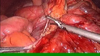 Laparoscopic Ladds procedure for adult malrotation with midgut volvulus Phani krishna Ravula