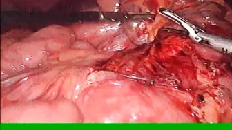 Laparoscopic Ladds procedure for adult malrotation with midgut volvulus Phani krishna Ravula #2