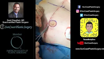 Mastectomies with free nipple grafting for female-to-male (FTM) gender transition #4