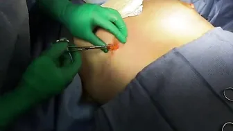 Male Puffy Nipple Surgery by XSCULPT #3