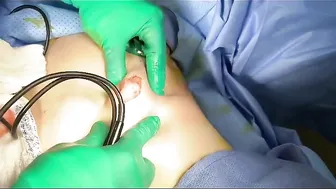 Male Puffy Nipple Surgery by XSCULPT #4