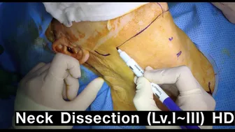 Neck dissection - level I ~ III HD (narrative)