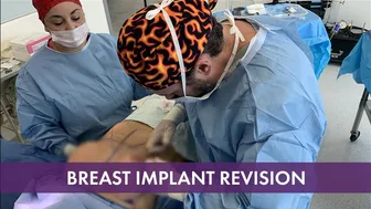 Breast Implant Exchange | Dr. Carlos Castañeda