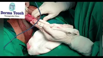 Gender change Surgery male to female with Labiaplasty.