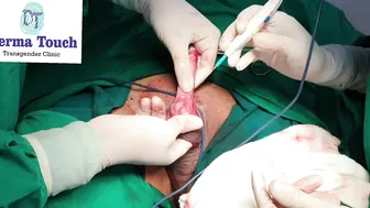 Gender change Surgery male to female with Labiaplasty. #2