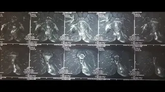 Role of Colostomy in anal Fistula Dr Ashish Bhanot