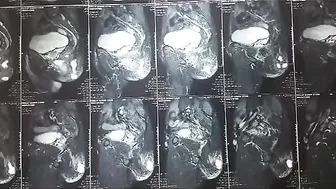 Role of Colostomy in anal Fistula Dr Ashish Bhanot #2