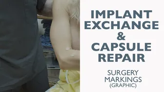 Pre-Surgery Surgery Markings Breast Implant Exchange