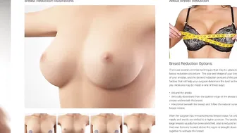 Dr Burk Talks About Breast Surgery #4