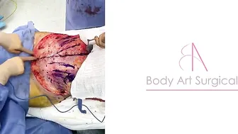 Body Art Surgical / Tummy Tuck #3