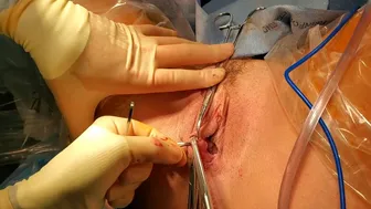 Bartholin's Gland Cyst- marsupialization surgery