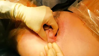 Bartholin's Gland Cyst- marsupialization surgery #2